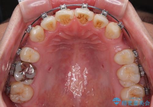 口が閉じにくい原因を根本から改善|上下顎4本抜歯による矯正治療症例の治療中