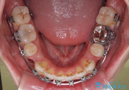 口が閉じにくい原因を根本から改善|上下顎4本抜歯による矯正治療症例の治療中