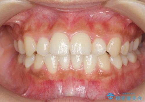 前歯のねじれ、すれ違いを改善 部分ワイヤー+マウスピース矯正の治療前