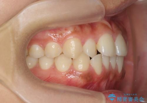 前歯のねじれ、すれ違いを改善　部分ワイヤー+マウスピース矯正の治療前