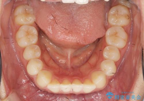 前歯のねじれ、すれ違いを改善　部分ワイヤー+マウスピース矯正の治療前
