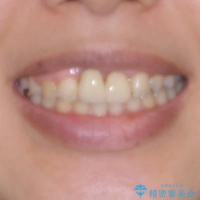 前歯のデコボコをワイヤー矯正で綺麗に 保険診療の前歯クラウンもセラミッククラウンで自然にの治療後(顔貌)