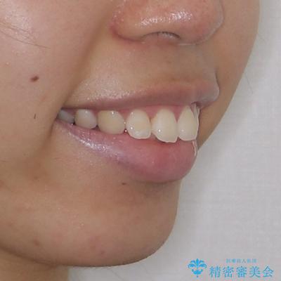 唇が閉じられない ワイヤー装置による抜歯矯正治療の治療前(顔貌)