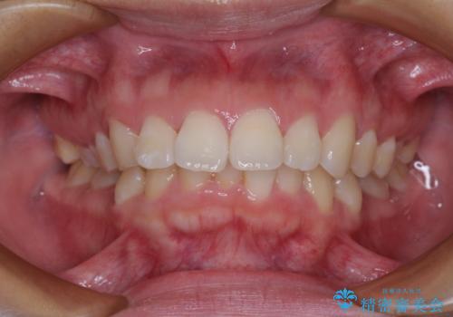 唇が閉じられない　ワイヤー装置による抜歯矯正治療の治療前