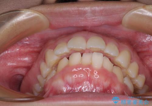 唇が閉じられない　ワイヤー装置による抜歯矯正治療の治療前