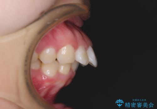 唇が閉じられない ワイヤー装置による抜歯矯正治療の治療前