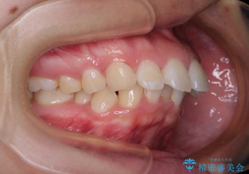 唇が閉じられない　ワイヤー装置による抜歯矯正治療の治療前