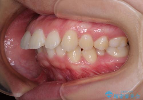 唇が閉じられない　ワイヤー装置による抜歯矯正治療の治療前