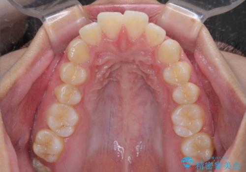 唇が閉じられない　ワイヤー装置による抜歯矯正治療の治療前