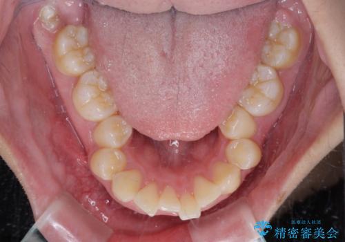 唇が閉じられない ワイヤー装置による抜歯矯正治療の治療前