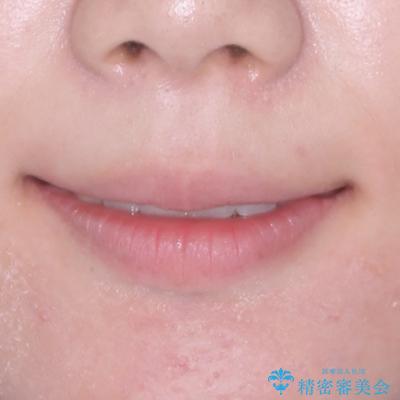 捻れて前に出ている前歯 ワイヤー装置での非抜歯矯正の治療後(顔貌)