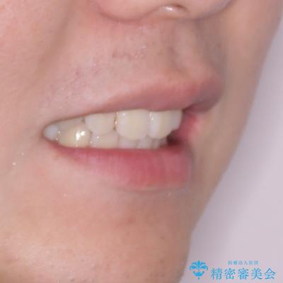 全体的なデコボコをスッキリと ワイヤー装置での抜歯矯正の治療後(顔貌)