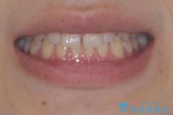 すきっ歯は放置NG?インビザラインで目立たず改善の治療前(顔貌)