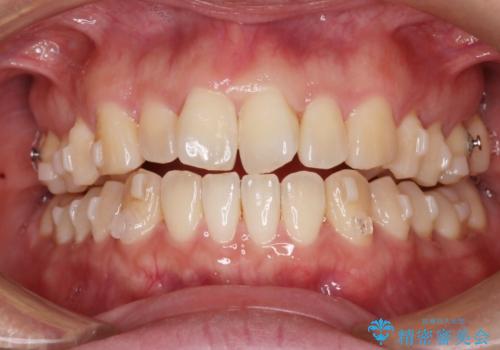 【インビザライン】前歯の捻れ気になるの治療中