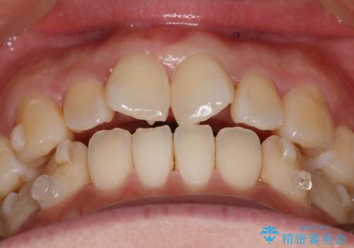 【インビザライン】前歯の捻れ気になるの治療中