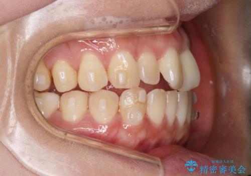 【インビザライン】前歯の捻れ気になるの治療中