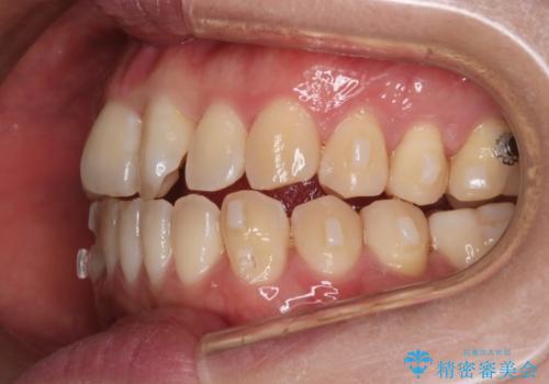【インビザライン】前歯の捻れ気になるの治療中