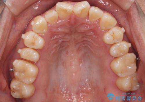 【インビザライン】前歯の捻れ気になるの治療中