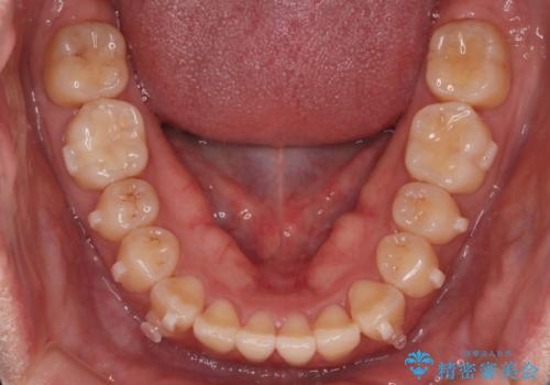 【インビザライン】前歯の捻れ気になるの治療中