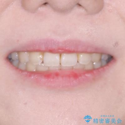 デコボコだらけの歯列をきれいに ワイヤー装置での抜歯矯正治療の治療後(顔貌)