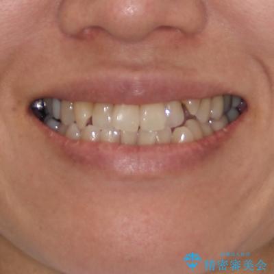 受け口と八重歯を改善 インビザライン矯正治療の治療前(顔貌)