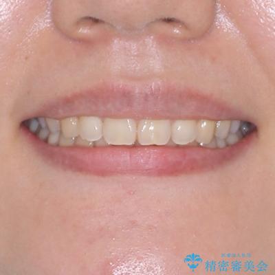隠れた前歯が気になる ディープバイトのワイヤー矯正治療の治療後(顔貌)