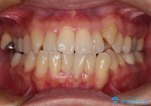 受け口と八重歯を改善 インビザライン矯正治療の症例 治療前