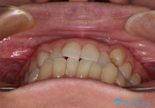 受け口と八重歯を改善 インビザライン矯正治療の治療前