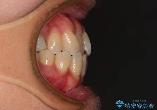 受け口と八重歯を改善　インビザライン矯正治療の治療前