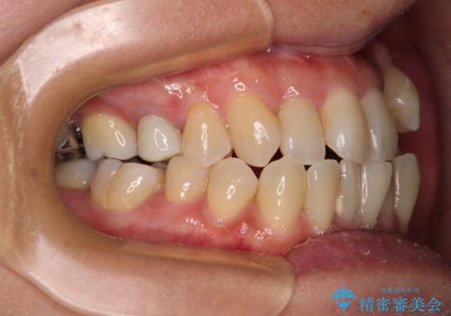 受け口と八重歯を改善　インビザライン矯正治療の治療前