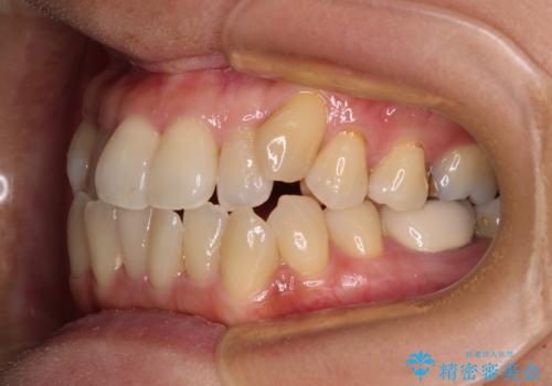 受け口と八重歯を改善 インビザライン矯正治療の治療前