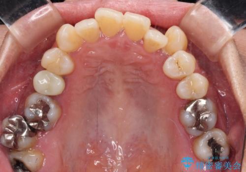 受け口と八重歯を改善　インビザライン矯正治療の治療前