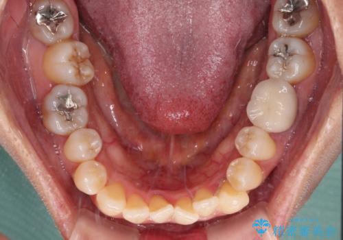 受け口と八重歯を改善　インビザライン矯正治療の治療前