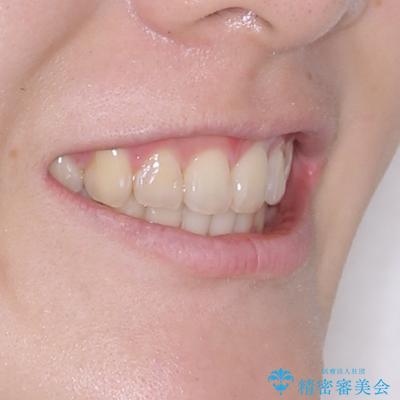 深い咬み合わせと飛び出した前歯 ワイヤー装置での抜歯矯正治療の治療後(顔貌)