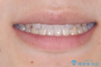 すきっ歯は放置NG?インビザラインで目立たず改善の治療後(顔貌)