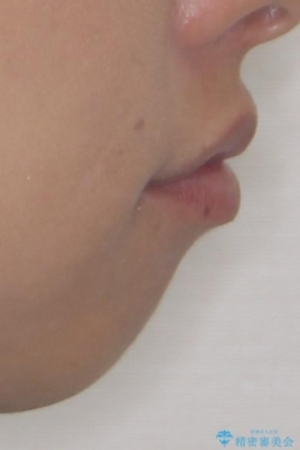 抜歯矯正で口が閉じやすく|ディープバイトと叢生を改善した症例の治療前(顔貌)