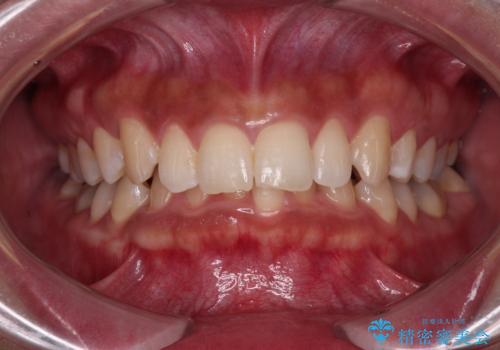 抜歯矯正で口が閉じやすく|ディープバイトと叢生を改善した症例の症例 治療前