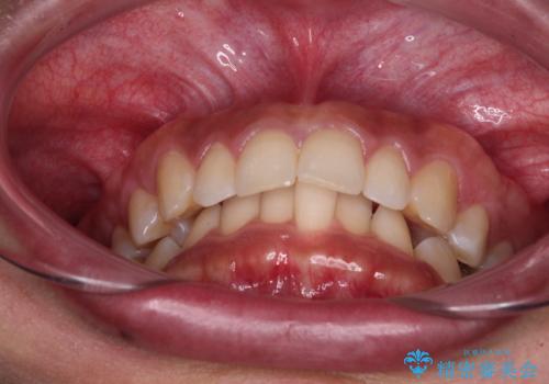 抜歯矯正で口が閉じやすく|ディープバイトと叢生を改善した症例の治療前