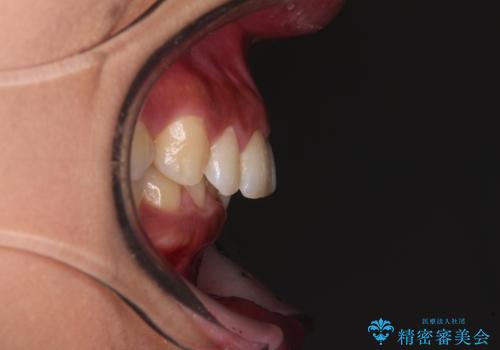 抜歯矯正で口が閉じやすく|ディープバイトと叢生を改善した症例の治療前