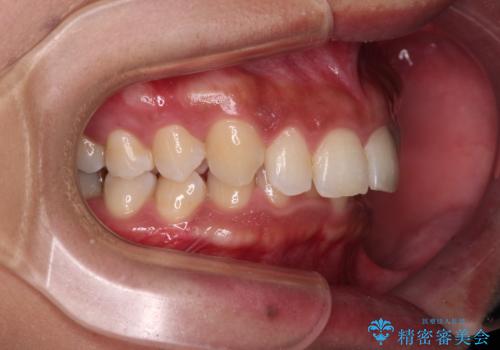 抜歯矯正で口が閉じやすく|ディープバイトと叢生を改善した症例の治療前