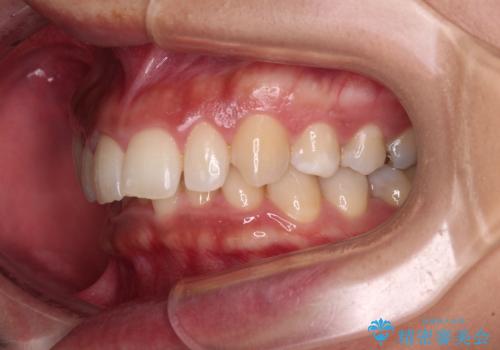 抜歯矯正で口が閉じやすく|ディープバイトと叢生を改善した症例の治療前