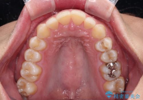 抜歯矯正で口が閉じやすく|ディープバイトと叢生を改善した症例の治療前