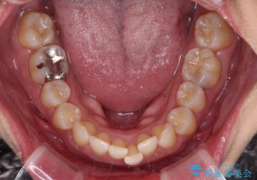 抜歯矯正で口が閉じやすく|ディープバイトと叢生を改善した症例の治療前