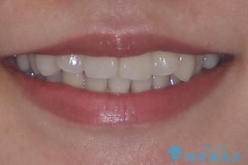 デコボコと正中のずれを改善した矯正治療の治療前(顔貌)