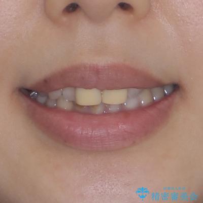 前歯のデコボコをワイヤー矯正で綺麗に 保険診療の前歯クラウンもセラミッククラウンで自然にの治療前(顔貌)