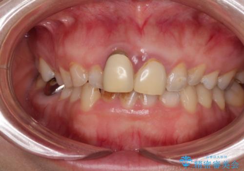 前歯のデコボコをワイヤー矯正で綺麗に　保険診療の前歯クラウンもセラミッククラウンで自然にの治療前