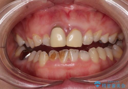 前歯のデコボコをワイヤー矯正で綺麗に　保険診療の前歯クラウンもセラミッククラウンで自然に