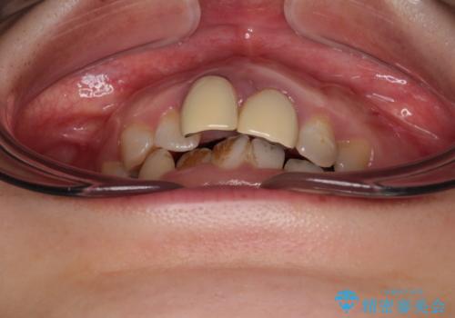 前歯のデコボコをワイヤー矯正で綺麗に 保険診療の前歯クラウンもセラミッククラウンで自然にの治療前