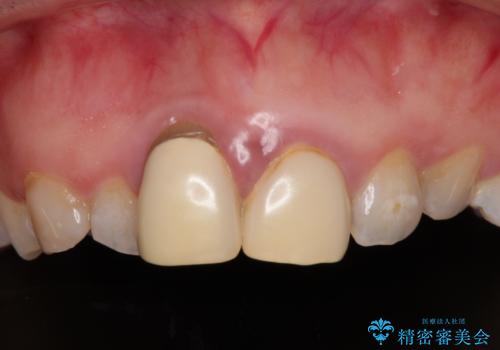 前歯のデコボコをワイヤー矯正で綺麗に　保険診療の前歯クラウンもセラミッククラウンで自然にの治療前
