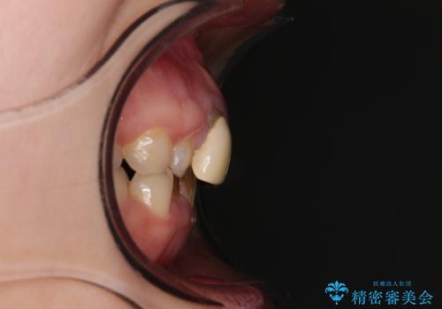 前歯のデコボコをワイヤー矯正で綺麗に　保険診療の前歯クラウンもセラミッククラウンで自然にの治療前